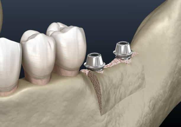 Exploring Development Alternatives within the Dental Membranes and Bone